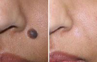 alunita neagra inainte si dupa